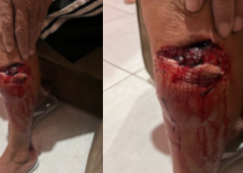 IMAGENS FORTES: Idoso é Atacado por Cães Soltos em bairro residencial de Campina Grande