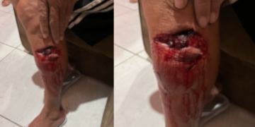 IMAGENS FORTES: Idoso é Atacado por Cães Soltos em bairro residencial de Campina Grande